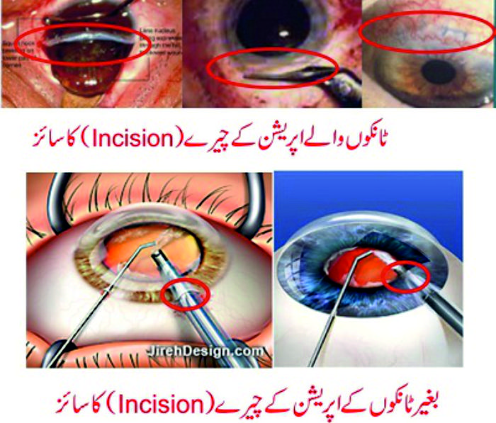 How cataract operation is performed?