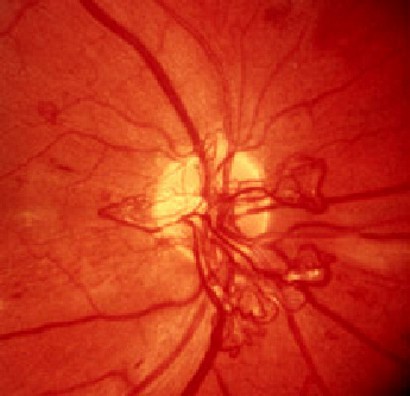 What defect develops in the retina?