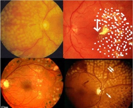 How diabetes damages the retina?