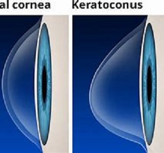 What is keratoconus?