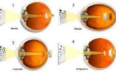 What is the reason of weakness of vision? Why people wear different types of glasses?