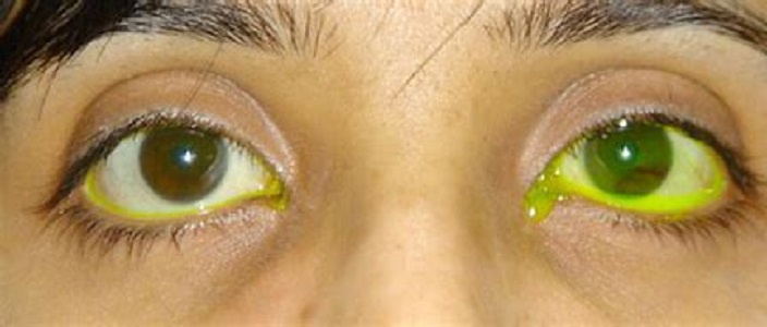 What are reasons of watering from eye?