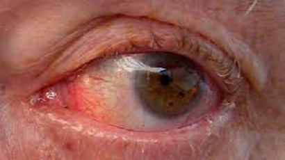 Symptoms of open angle glaucoma
