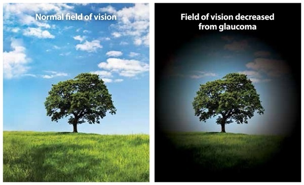 Signs of narrow angle glaucoma: a type of glaucoma