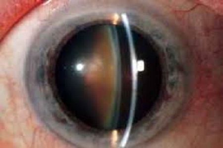 When should cataract surgery be performed? Right now I see enough. Why should I be operated?