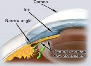 What is the basic fault in narrow angle glaucoma?