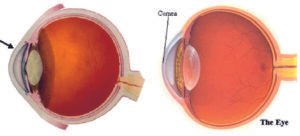 Cataract image vs clear lens