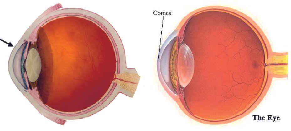 Cataract image vs clear lens