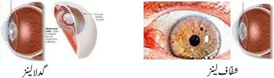 How cataract appears