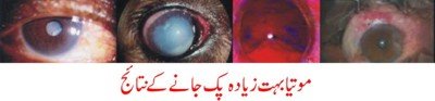 Hypermature cataract