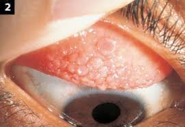 Contact allergy due to contact lenses