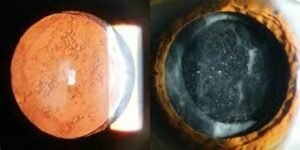 Posterior capsule thickening