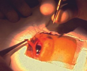 Levator resection
