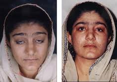 Ptosis surgery