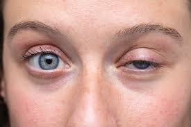 Ptosis patient
