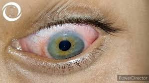 Spring catarrh