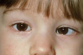 Child having squint