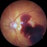 Retina bleeding
