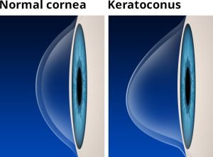 Basic defect in keratoconus