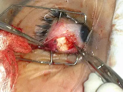 Squint repair