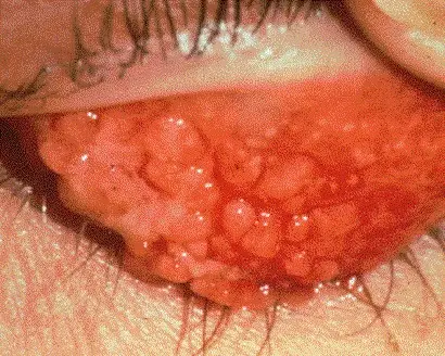 Allergy complications