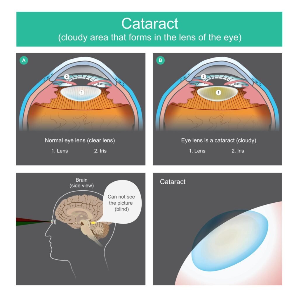 cataract mechanism