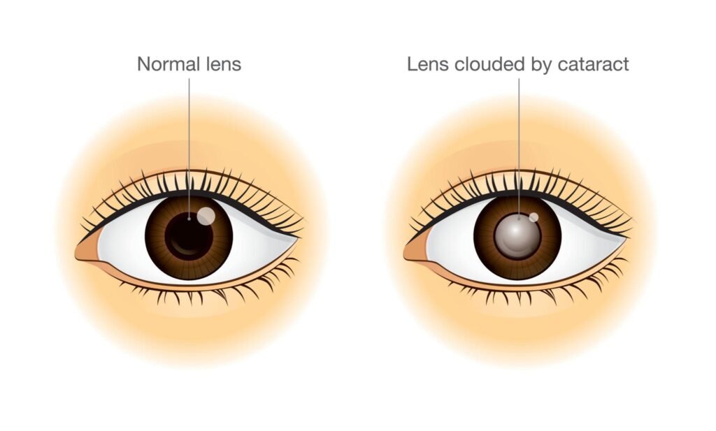 How eye appears in cataract