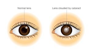 How eye appears in cataract