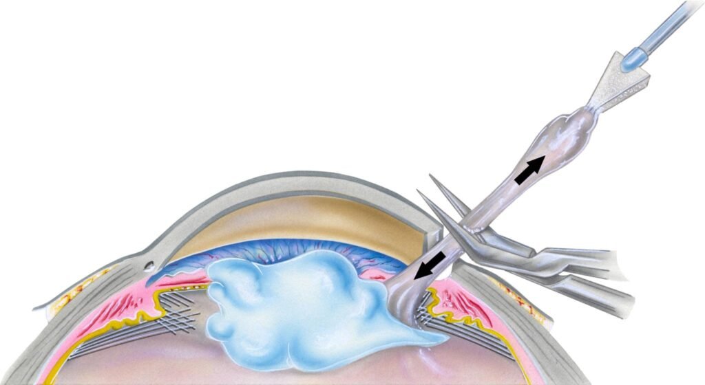 how cataract is removed?