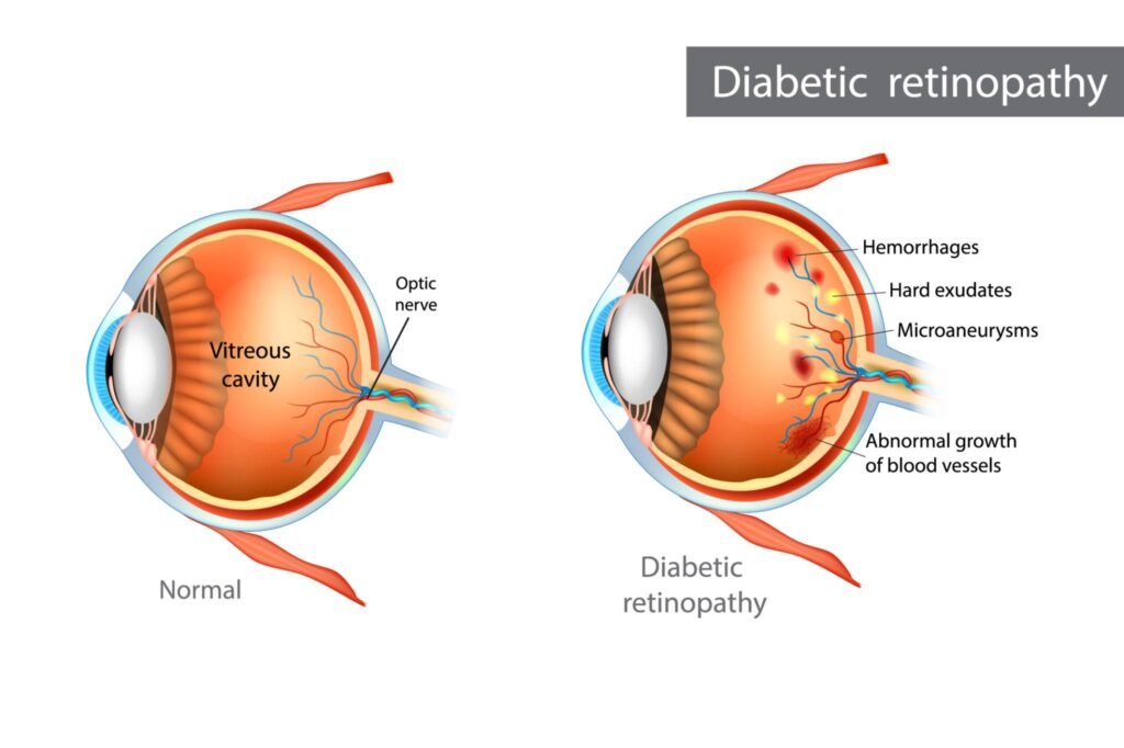 Vitreous hemorrhage