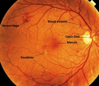 Diabetic retinopathy