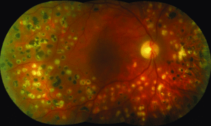 PRP retina